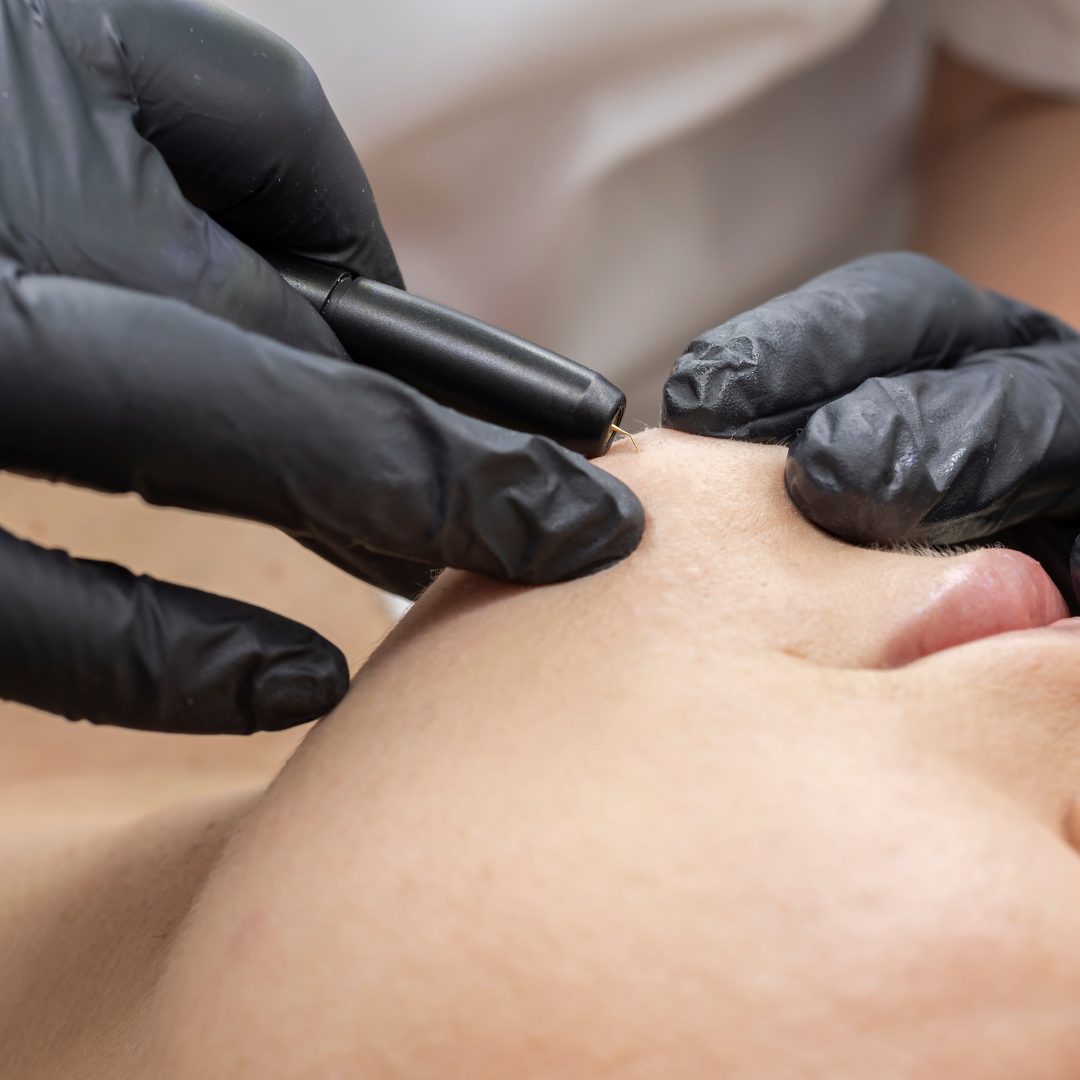 microneedling docteur nativelle lisieux deauville médecine esthétique et vasculaire